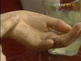 손가락 수술 7번의 악몽