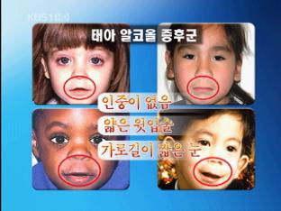 ‘임신 중 음주’ 태아 알코올 증후군 위험