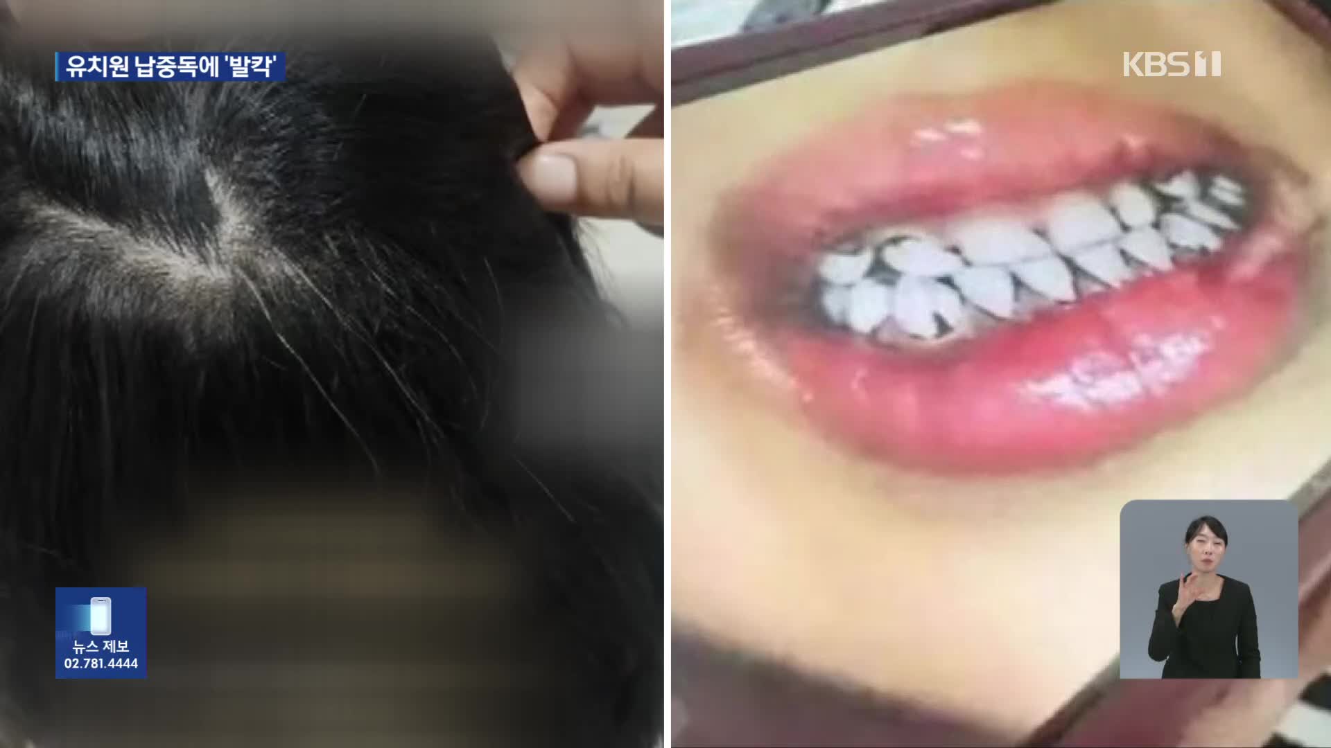 유치원생 흰머리에 이가 까맣게…떡·옥수수에 납 성분 첨가제