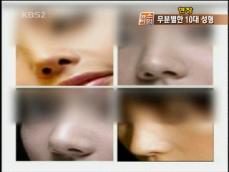 [현장] 무분별한 10대 성형…부작용 심각 