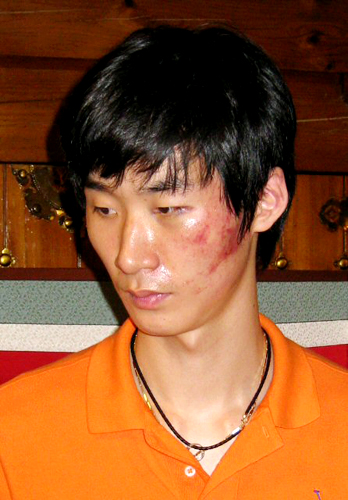 배구 아시아 남자선수권 대회 국가대표로 뽑혀 태릉선수촌에서 훈련을 하던 배구 국가대표 박철우가 지난 17일 코칭스태프에게 폭행당해 얼굴과 복부에 상해를 입었다며 18일 저녁 압구정동 한 음식점에서 기자회견을 하고 있다. 